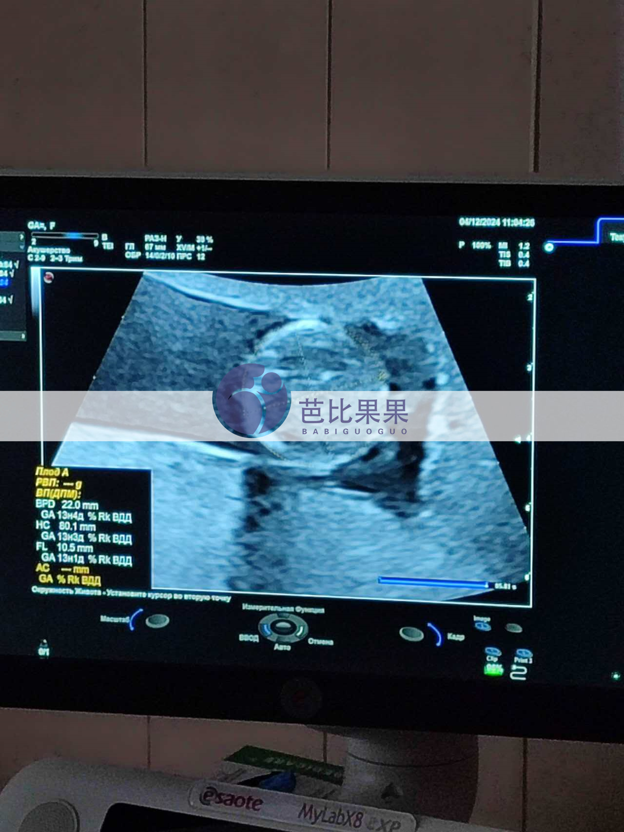 试管妈妈孕13周