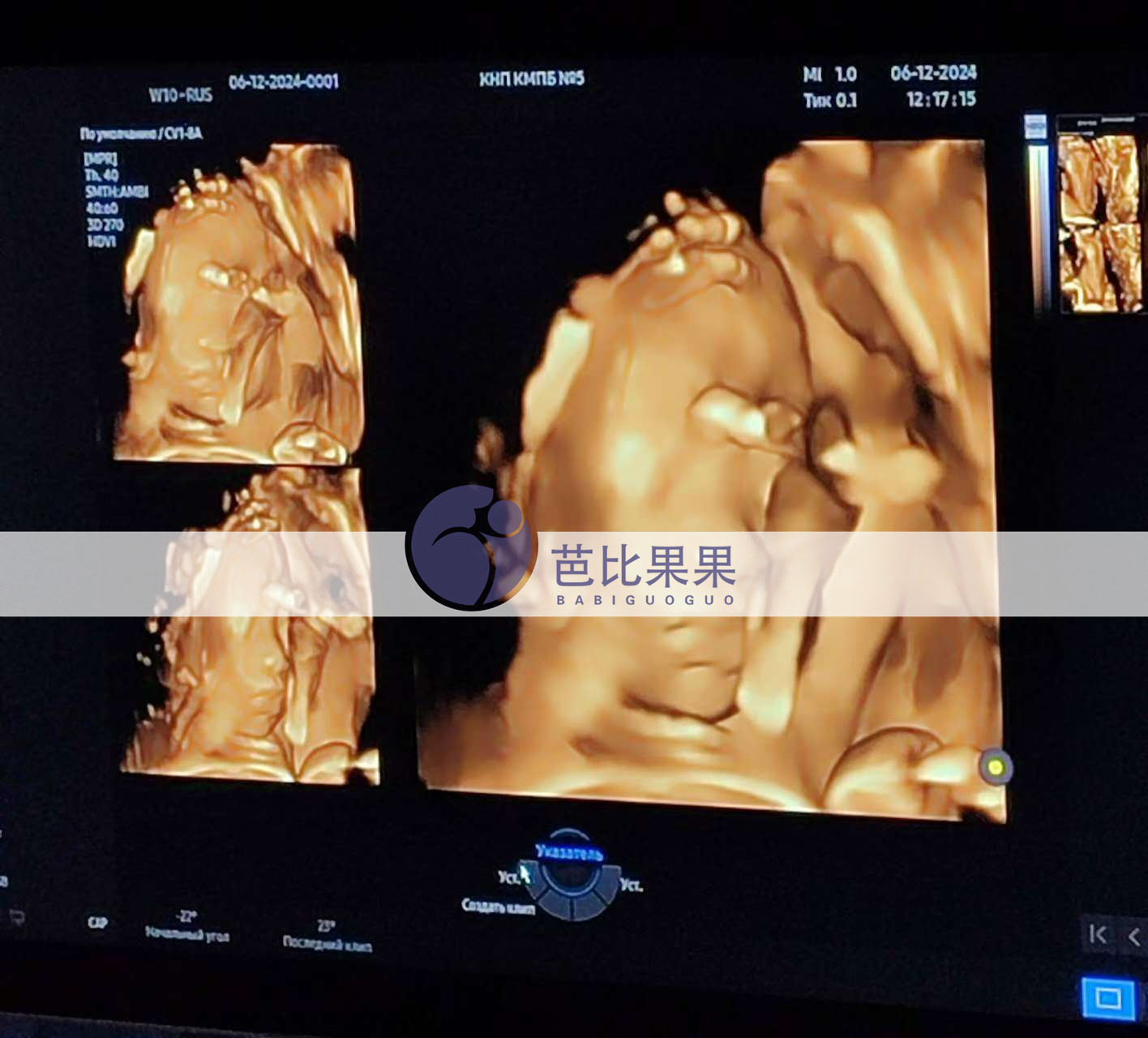 试管妈妈做四维彩超