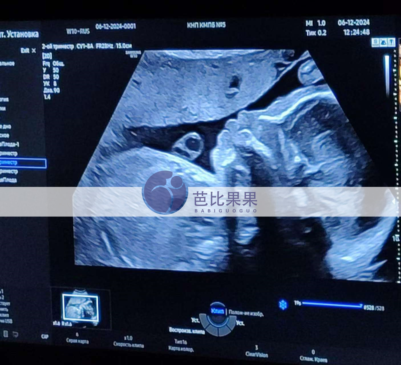 试管妈妈做四维彩超