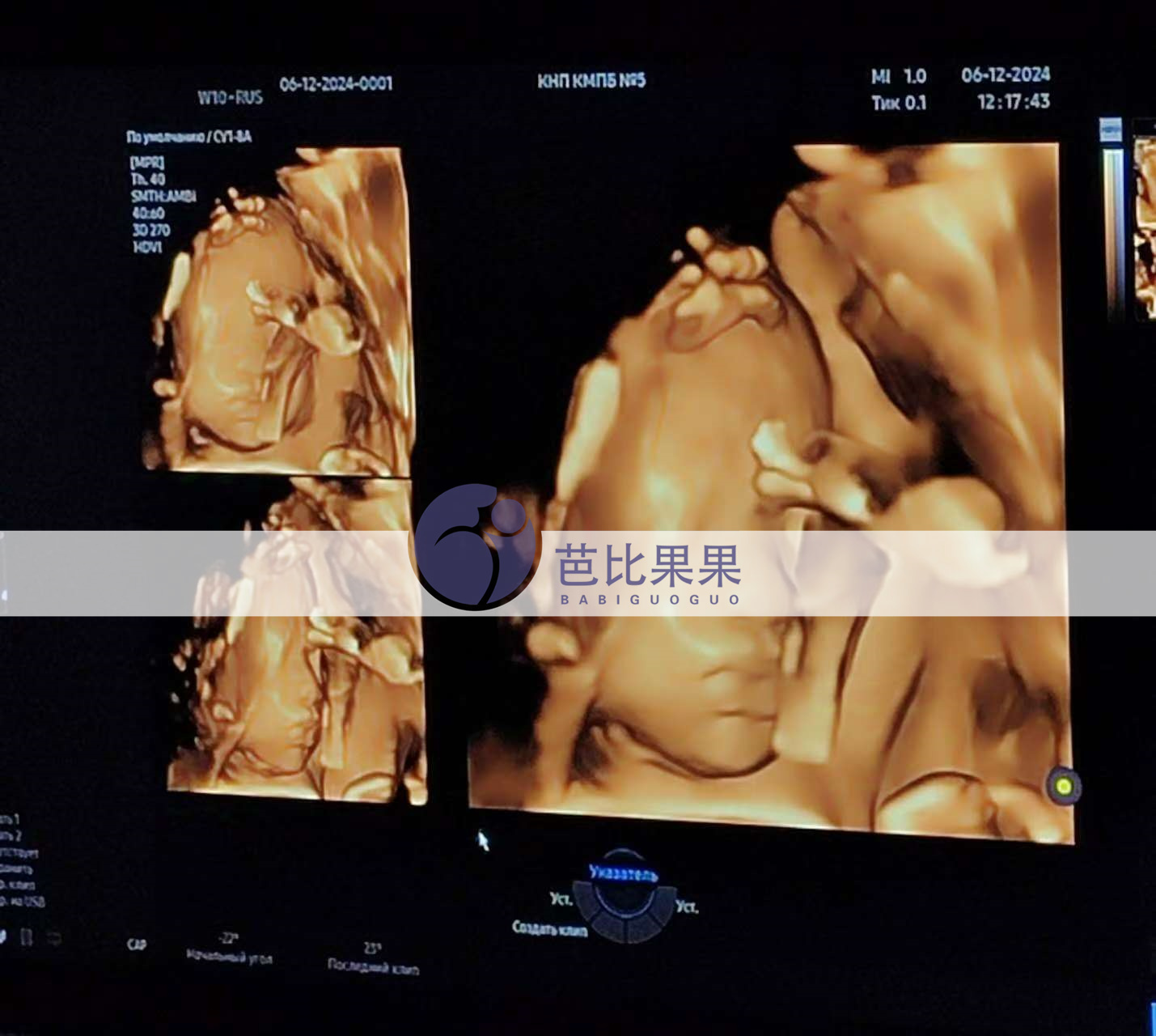 试管妈妈做四维彩超
