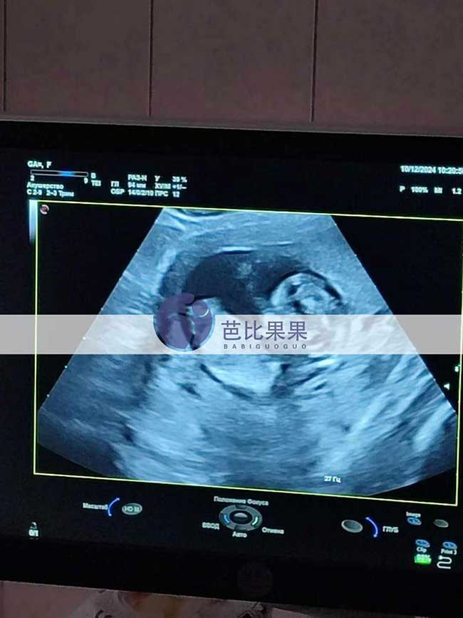 试管妈妈孕10周B超