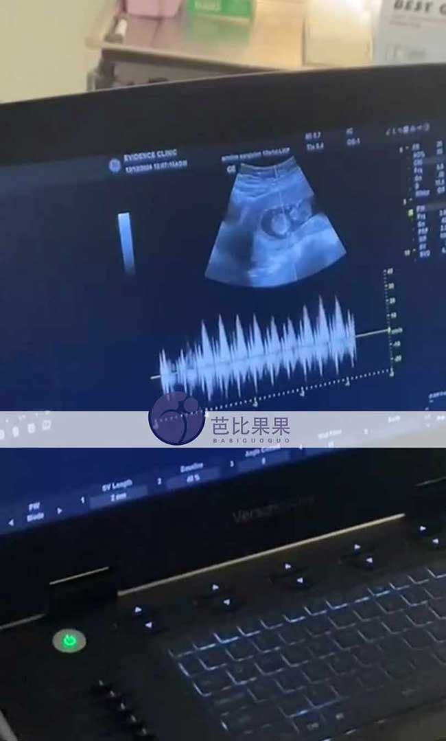 试管妈妈孕12周