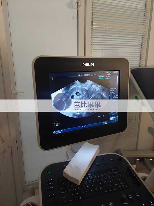试管妈妈着床双胞胎