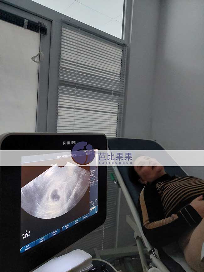 黄先生在格鲁吉亚试管匹配的试管妈妈怀双胞胎做第一次B超