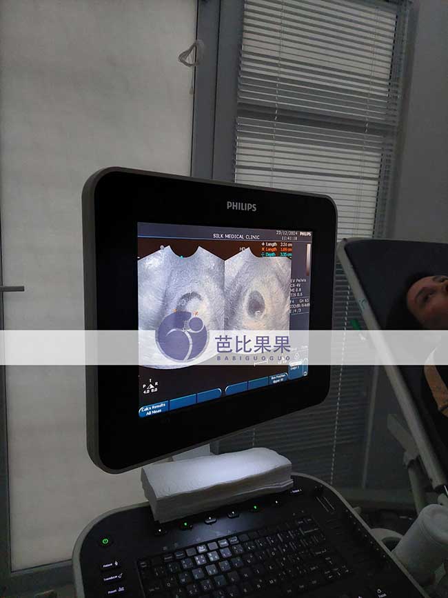 试管妈妈第一次B超