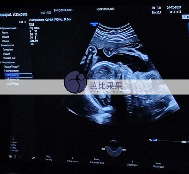 试管妈妈做四维彩超