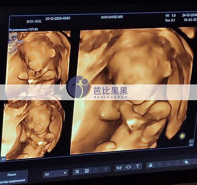 试管妈妈做四维彩超