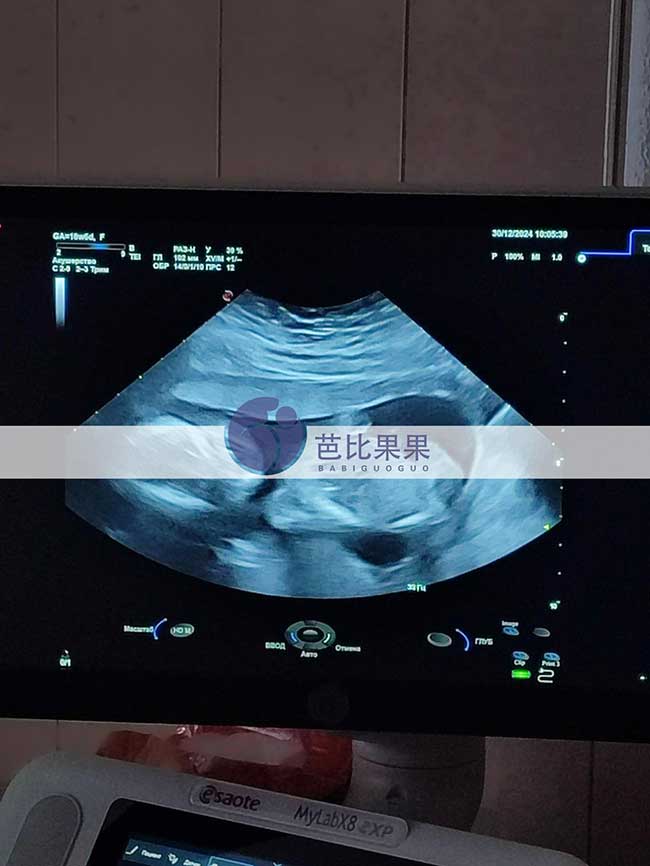 试管妈妈B超检查