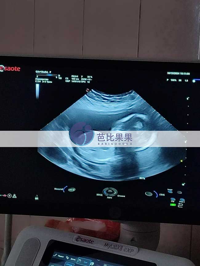 试管妈妈B超检查