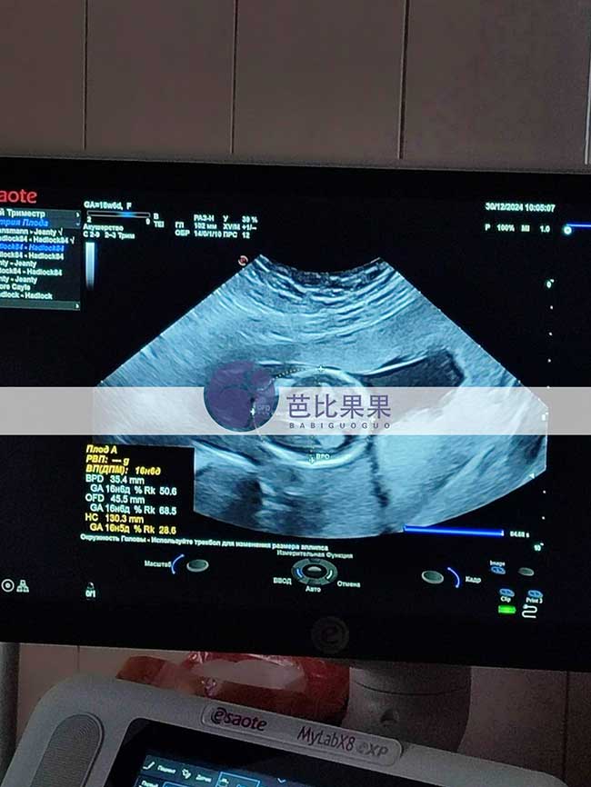 试管妈妈B超检查