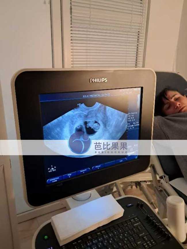 试管妈妈B超检查