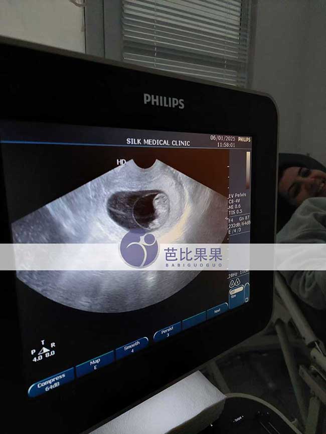 试管妈妈B超检查