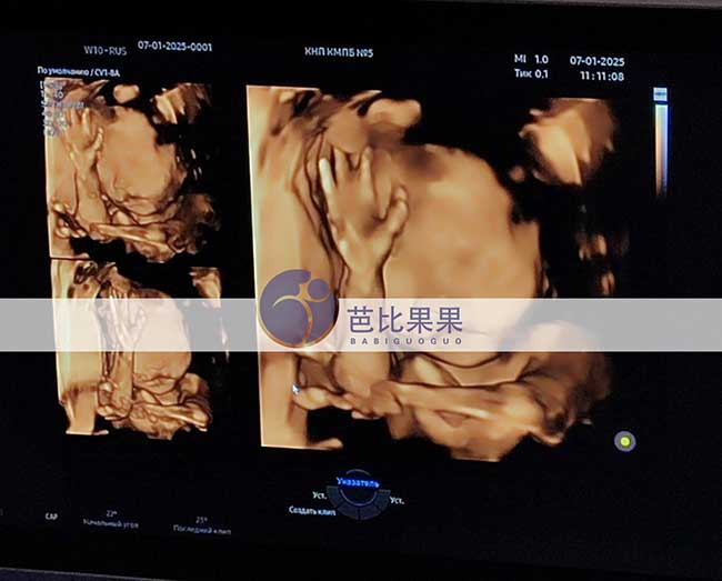 试管妈妈做四维彩超