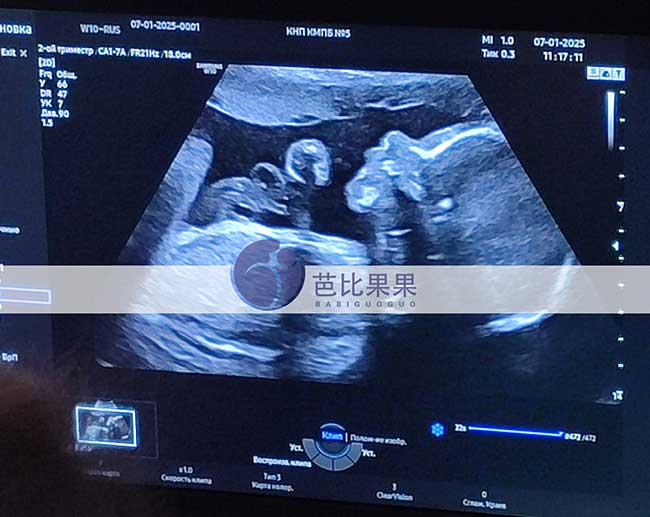 试管妈妈做四维彩超