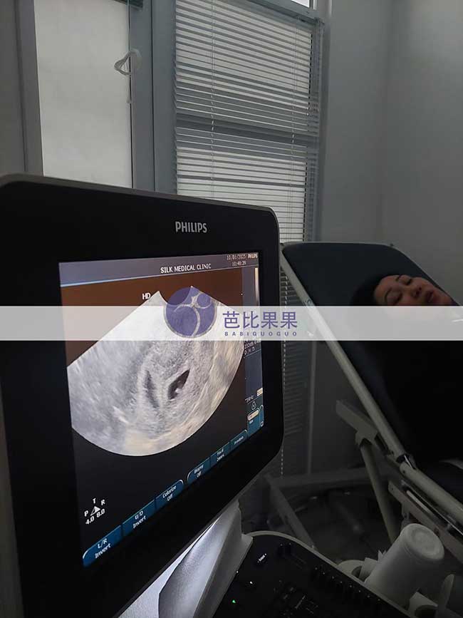 试管妈妈首次B超检查