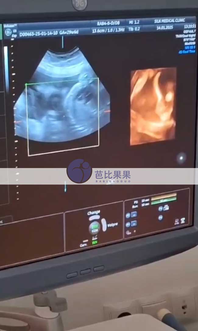 试管妈妈B超检查