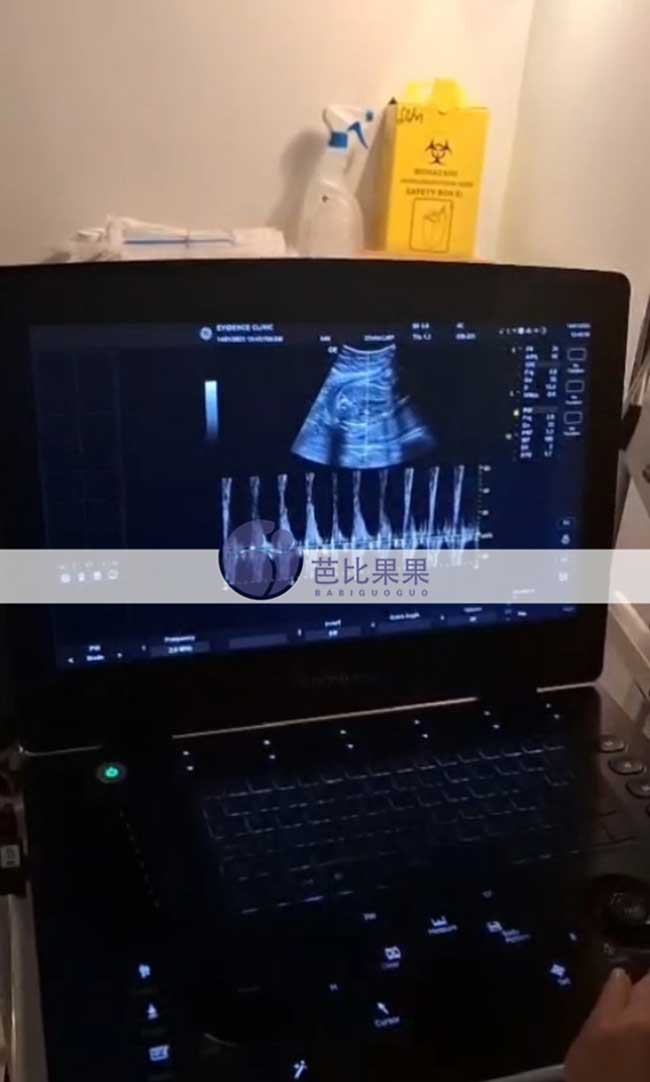 试管妈妈B超检查