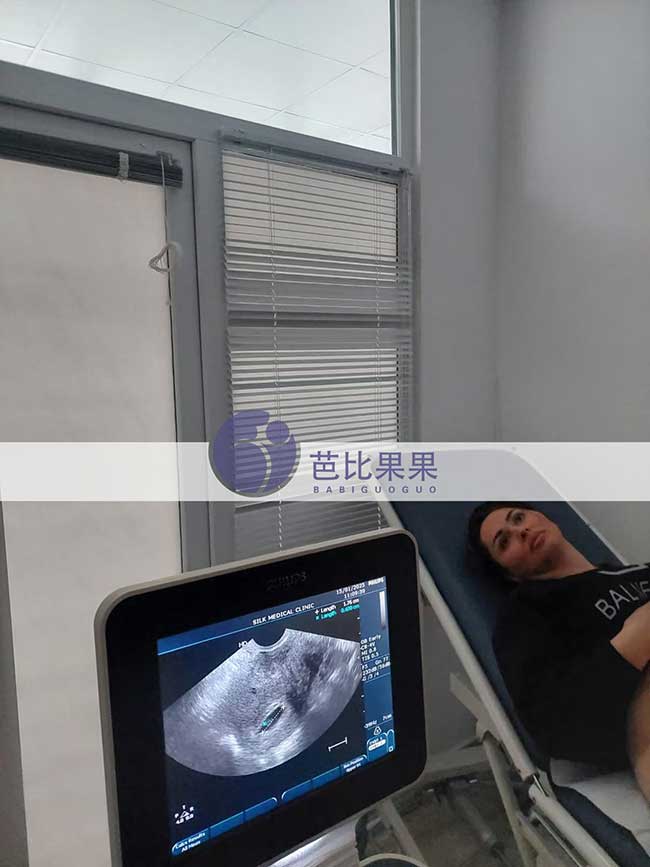 试管妈妈首次B超