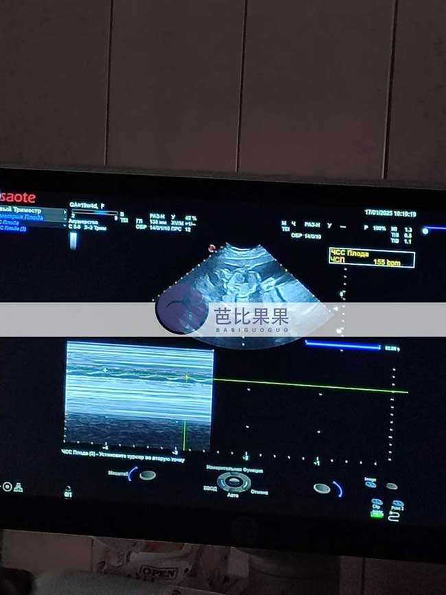双胞胎试管妈妈B超检查