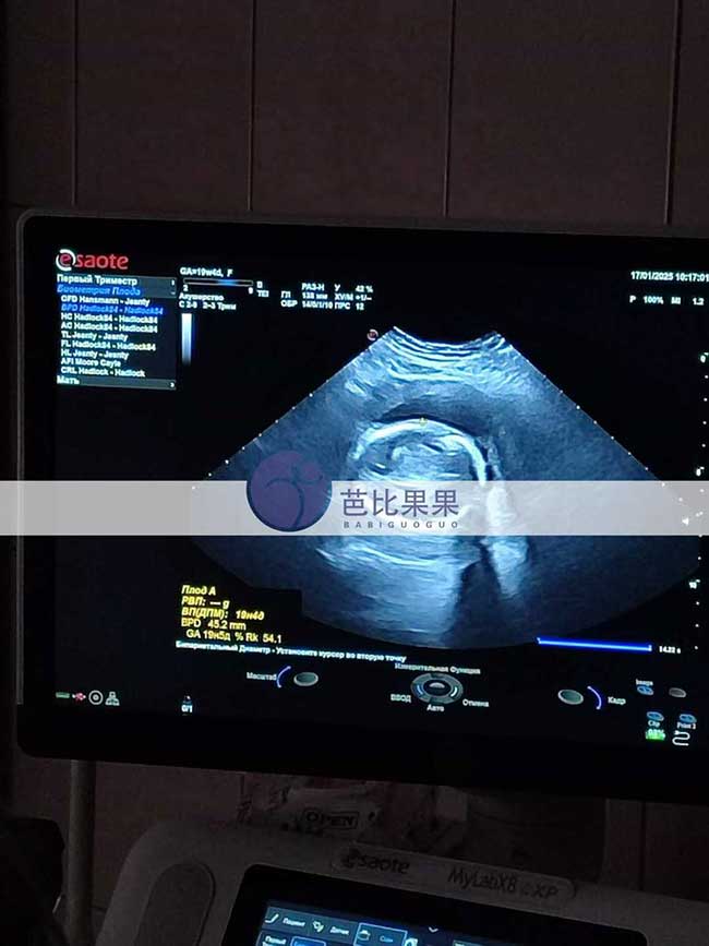 双胞胎试管妈妈B超检查