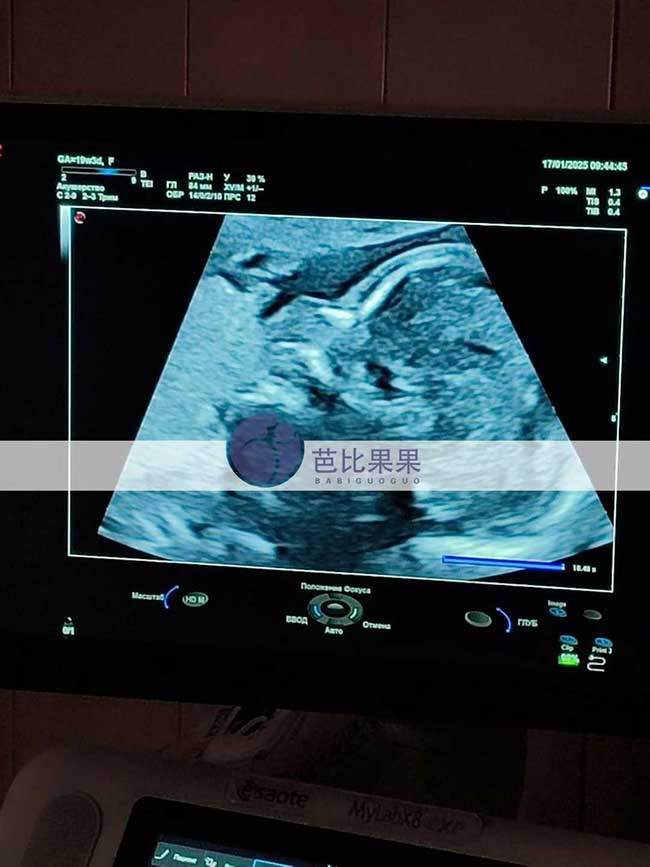 双胞胎试管妈妈B超检查