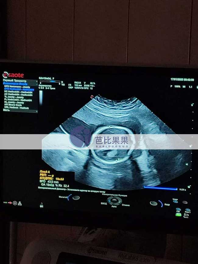双胞胎试管妈妈B超检查