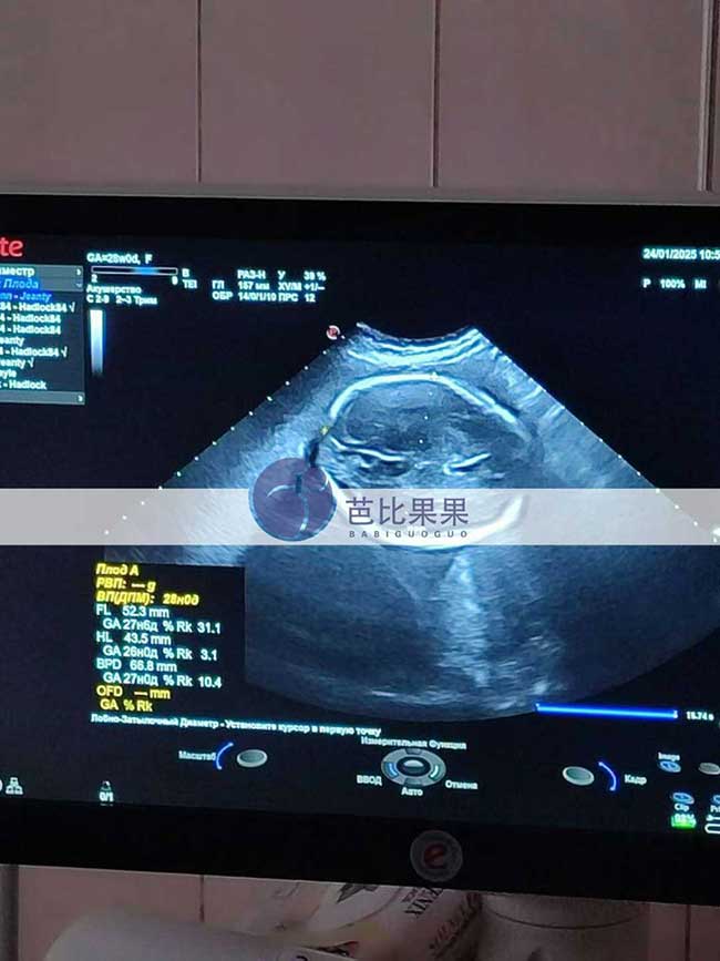 试管妈妈做B超