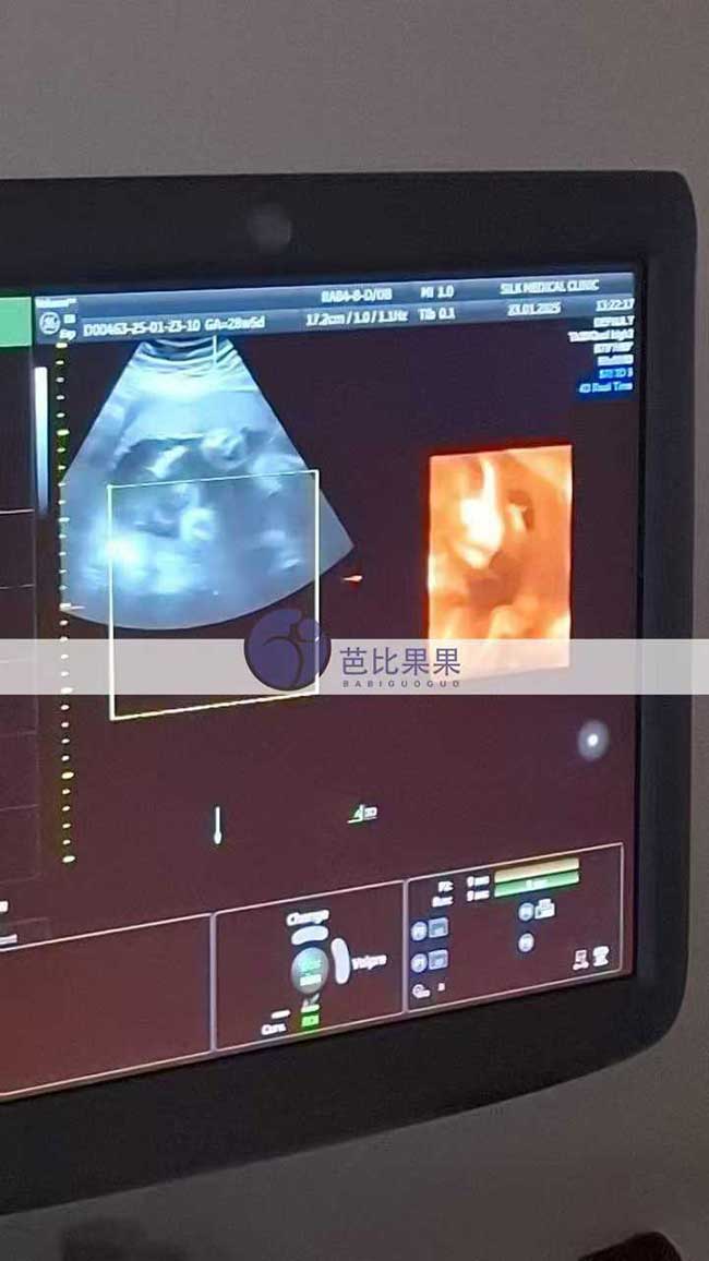 试管妈妈做四维彩超