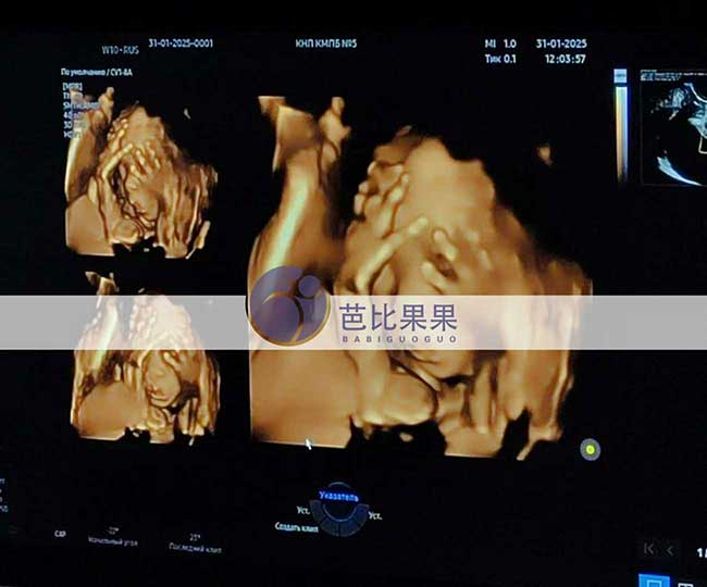 试管妈妈做四维彩超