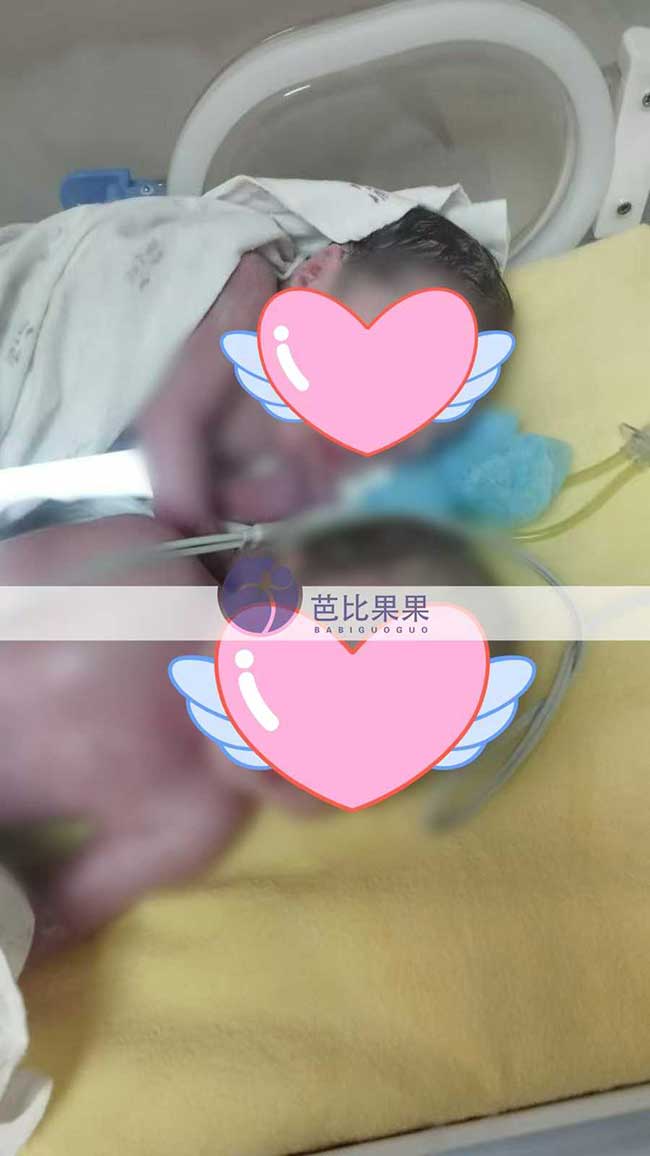 湖北黄先生在格鲁吉亚试管的双胞胎男宝顺产出生
