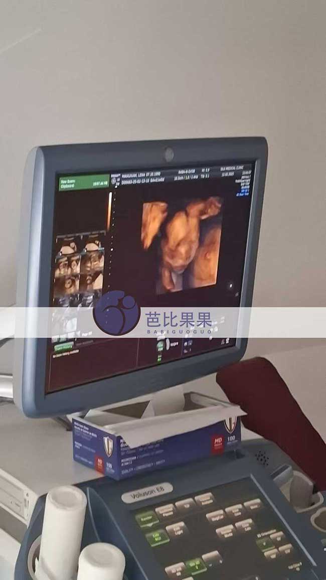 试管妈妈做四维彩超
