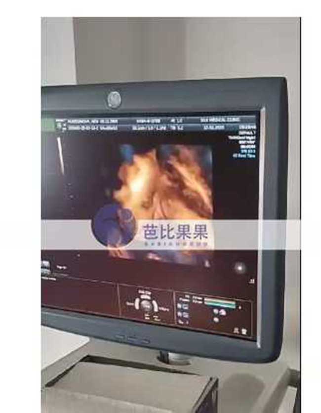试管妈妈做四维彩超