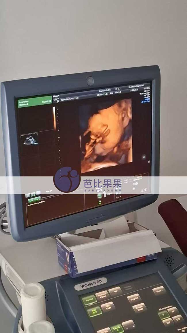 试管妈妈做四维彩超