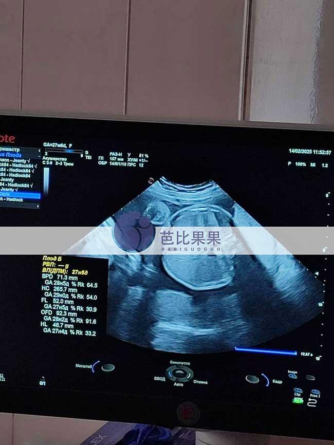 试管妈妈做B超