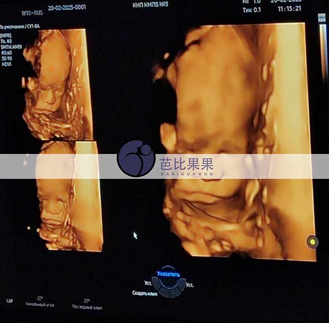 试管妈妈做四维彩超