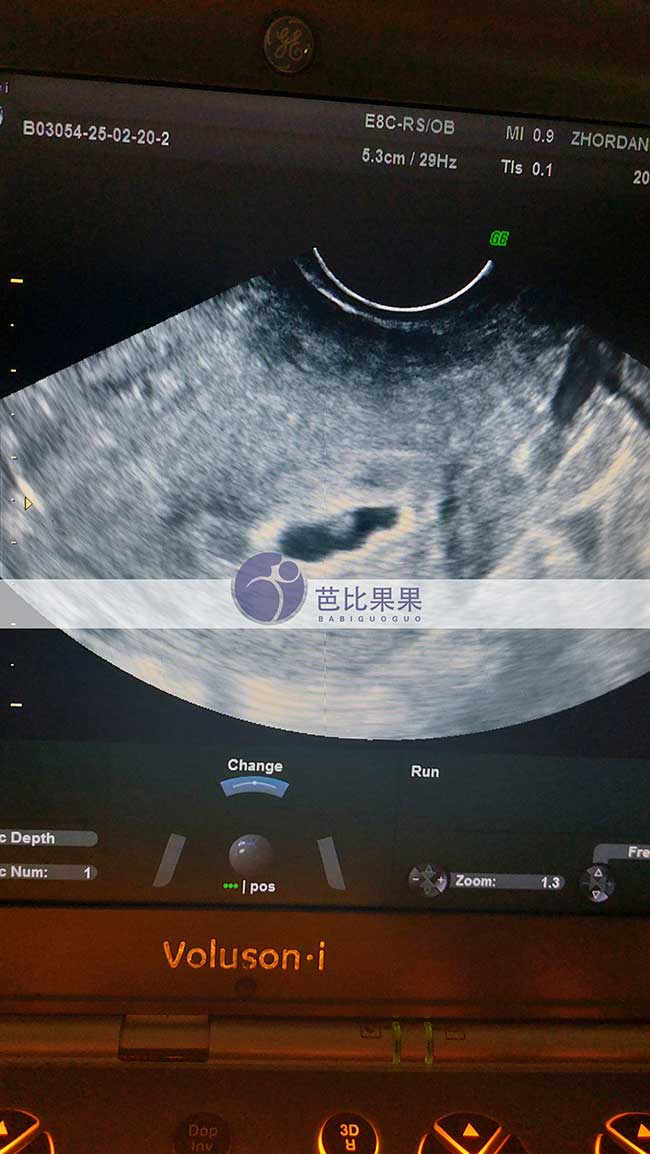 试管妈妈做B超