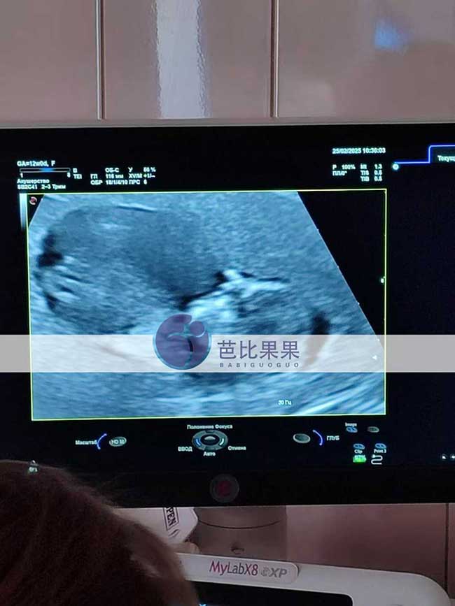 试管妈妈做B超