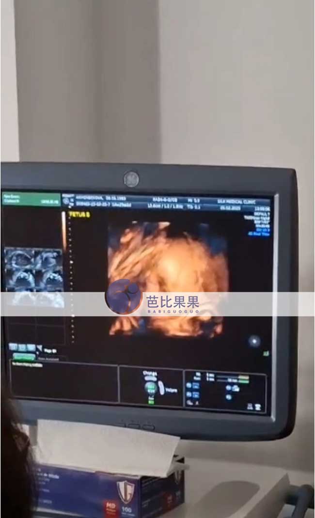 试管妈妈做B超