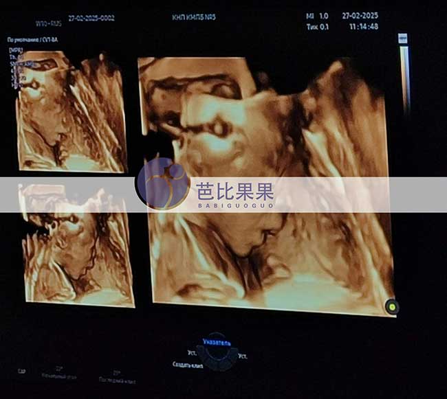 试管妈妈做B超