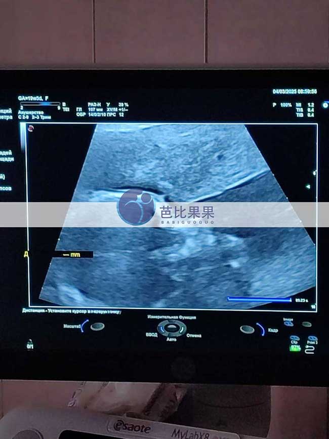 试管妈妈做B超