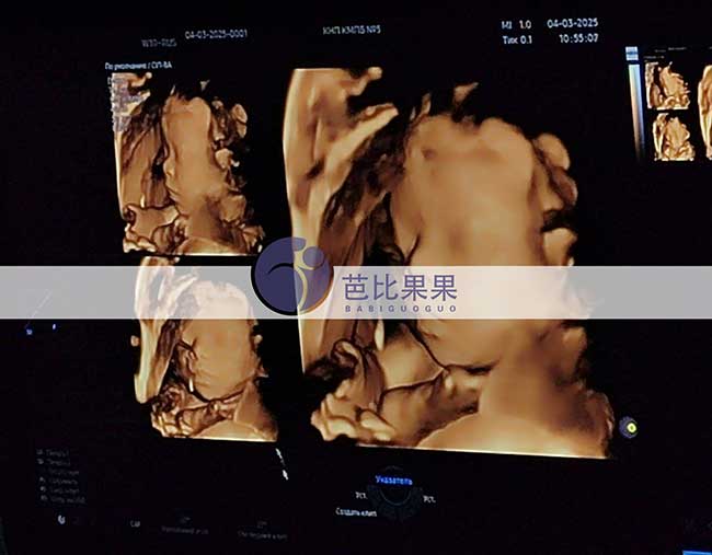 试管妈妈做四维彩超