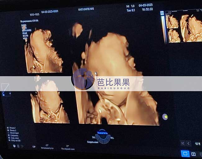 试管妈妈做四维彩超