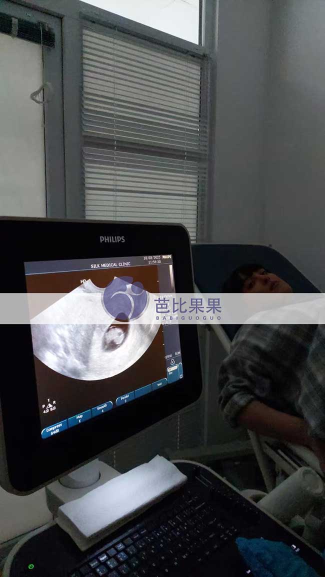 试管妈妈做B超