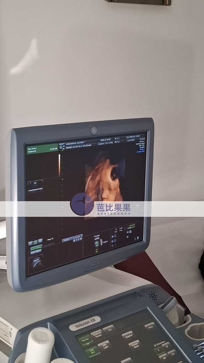 试管妈妈做四维彩超