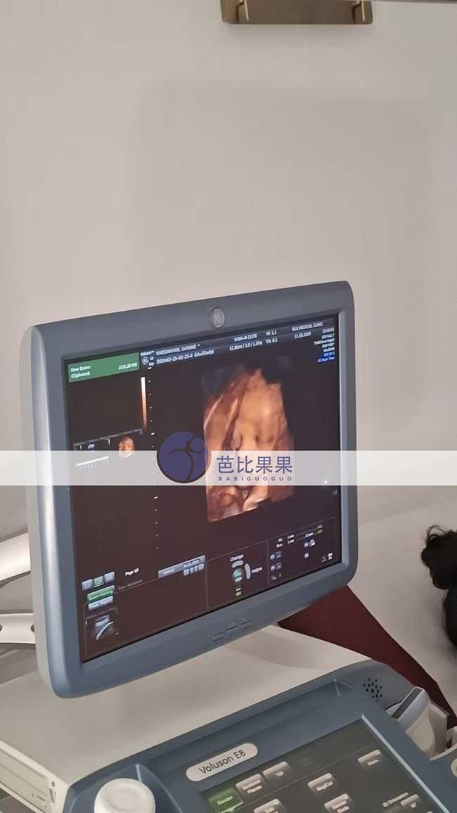 试管妈妈做四维彩超