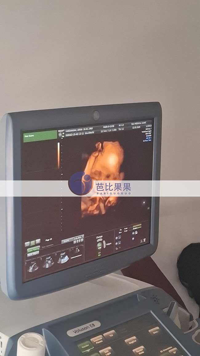 试管妈妈做B超