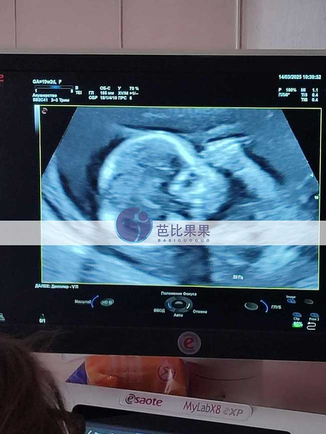 试管妈妈做B超