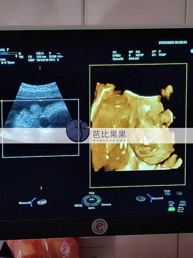试管妈妈做四维彩超