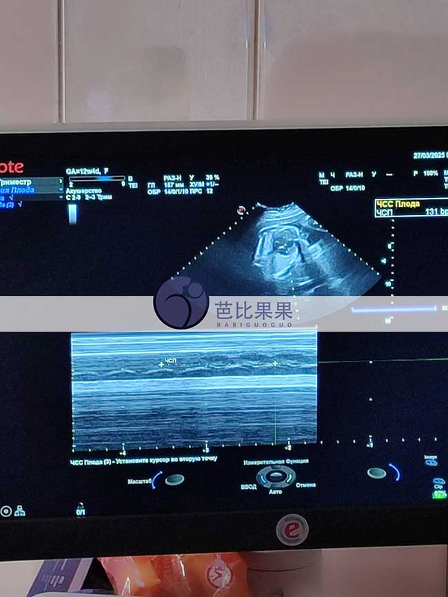 试管妈妈做四维彩超