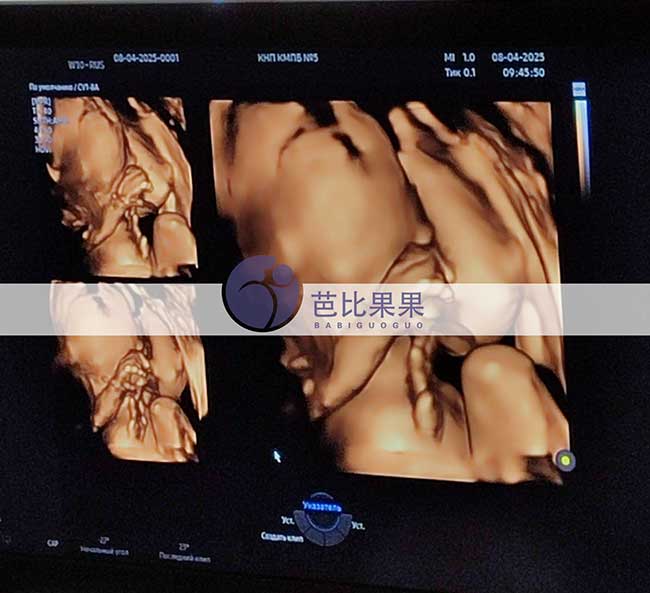试管妈妈做四维彩超